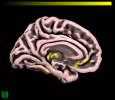 mri project